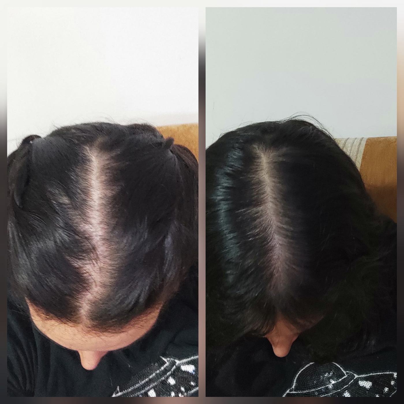 Capilar — fotografía clínica real