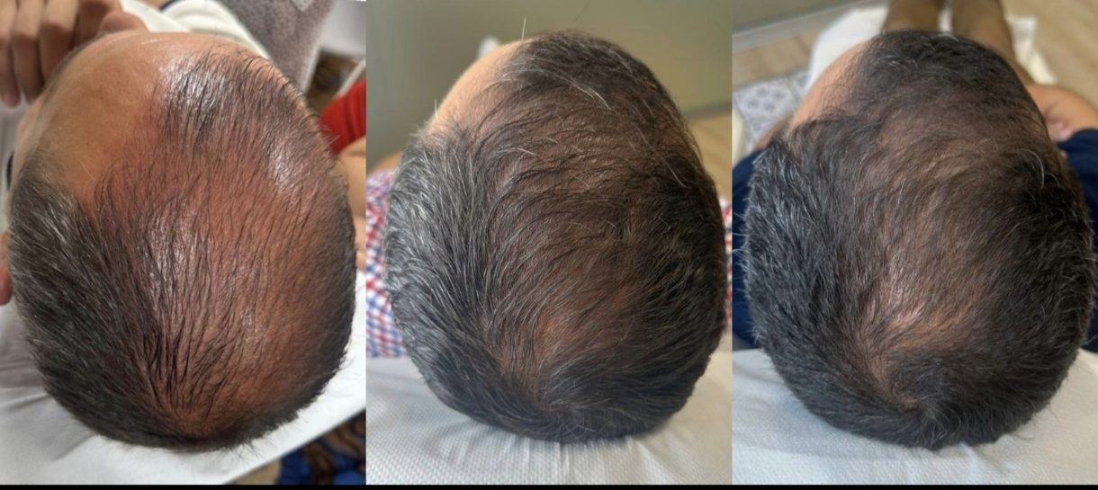 Capilar — fotografía clínica real
