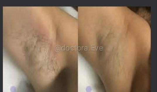 Depilación — fotografía clínica real