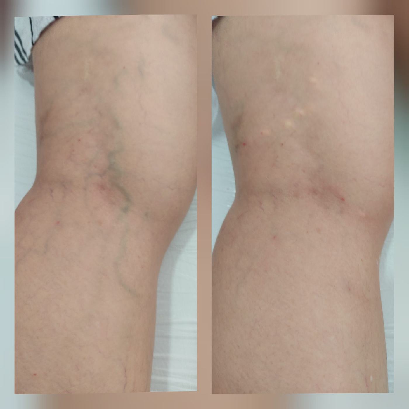 Escleroterapia — fotografía clínica real