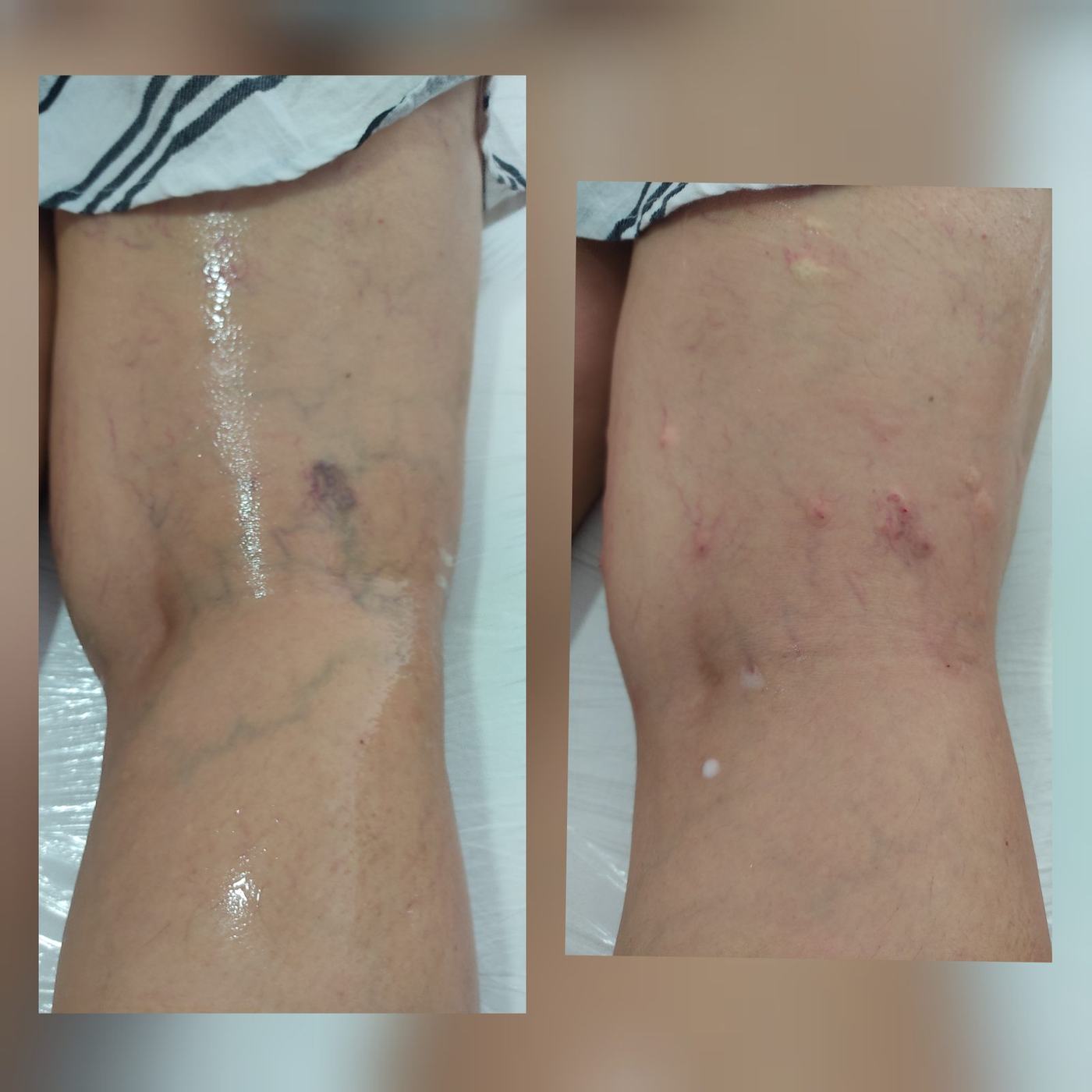 Escleroterapia — fotografía clínica real