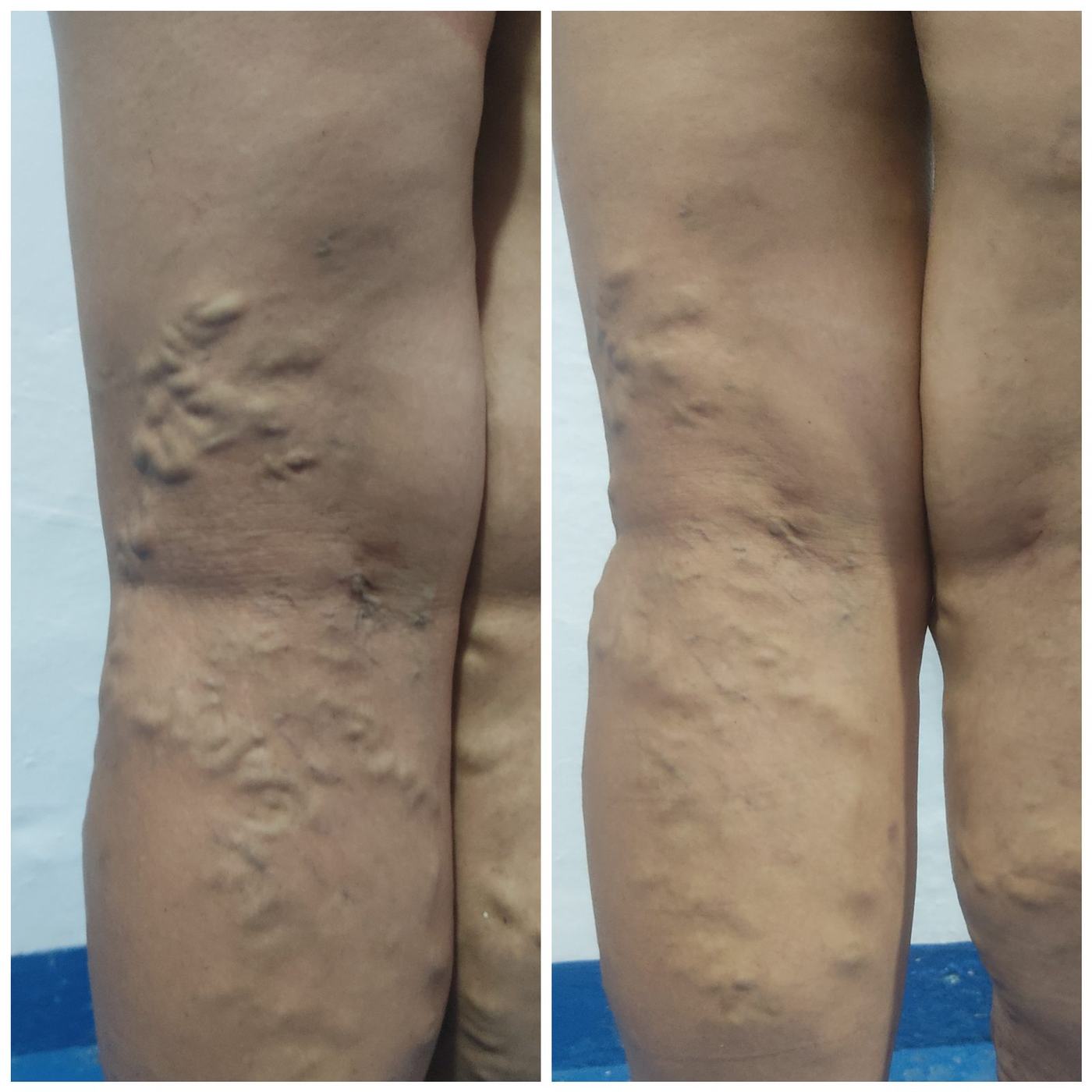 Escleroterapia — fotografía clínica real