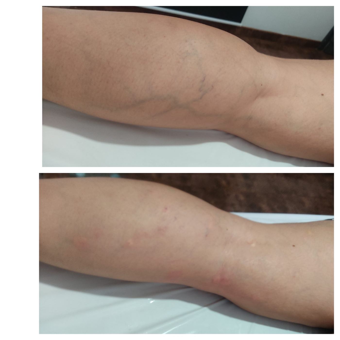 Escleroterapia — fotografía clínica real