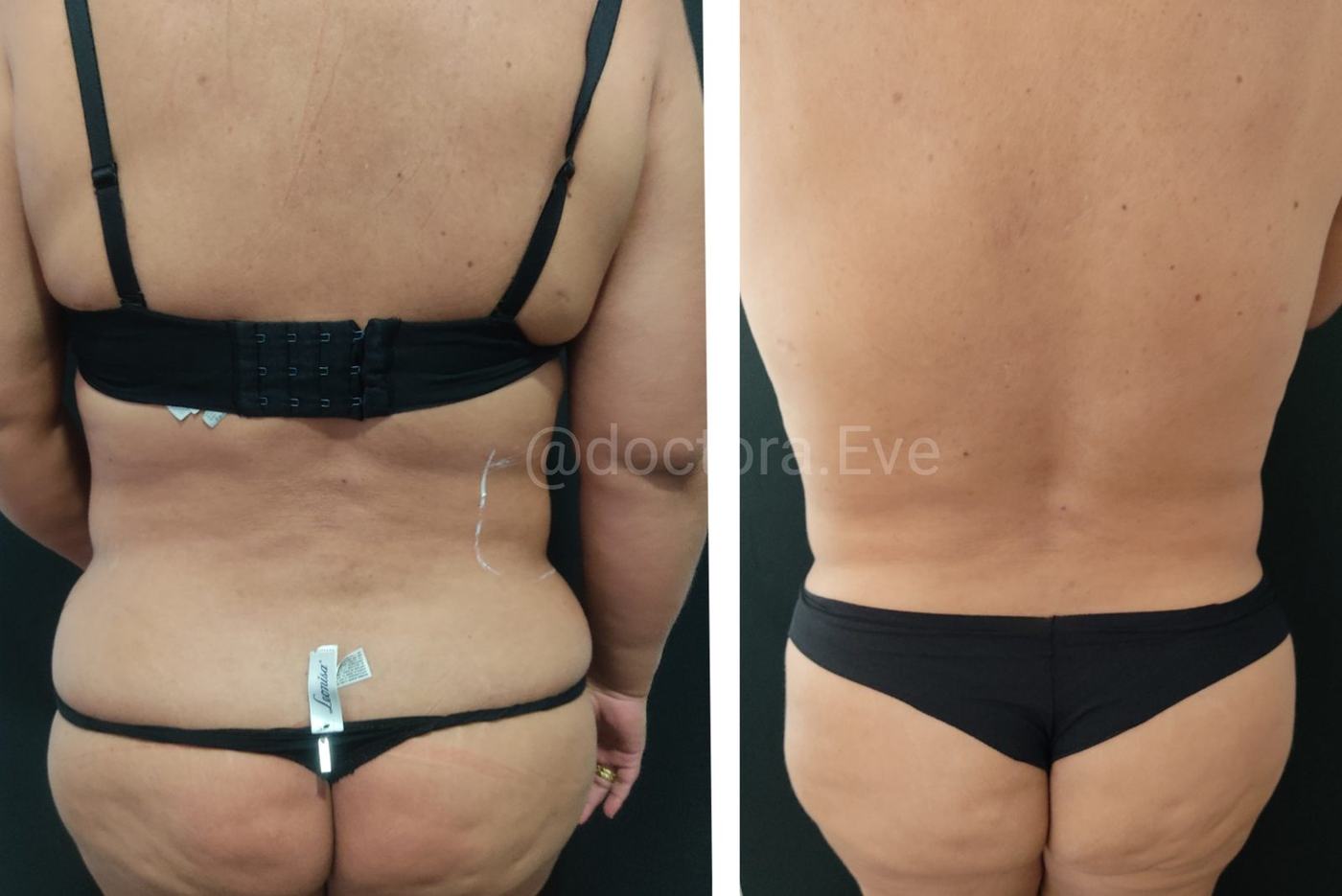 Lipoenzimas y fibrosis — fotografía clínica real