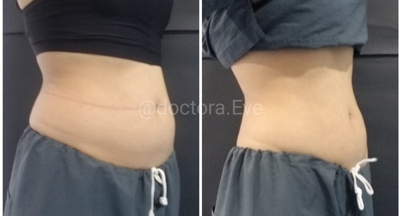Lipoenzimas y fibrosis — fotografía clínica real