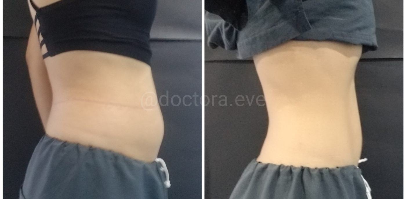 Lipoenzimas y fibrosis — fotografía clínica real