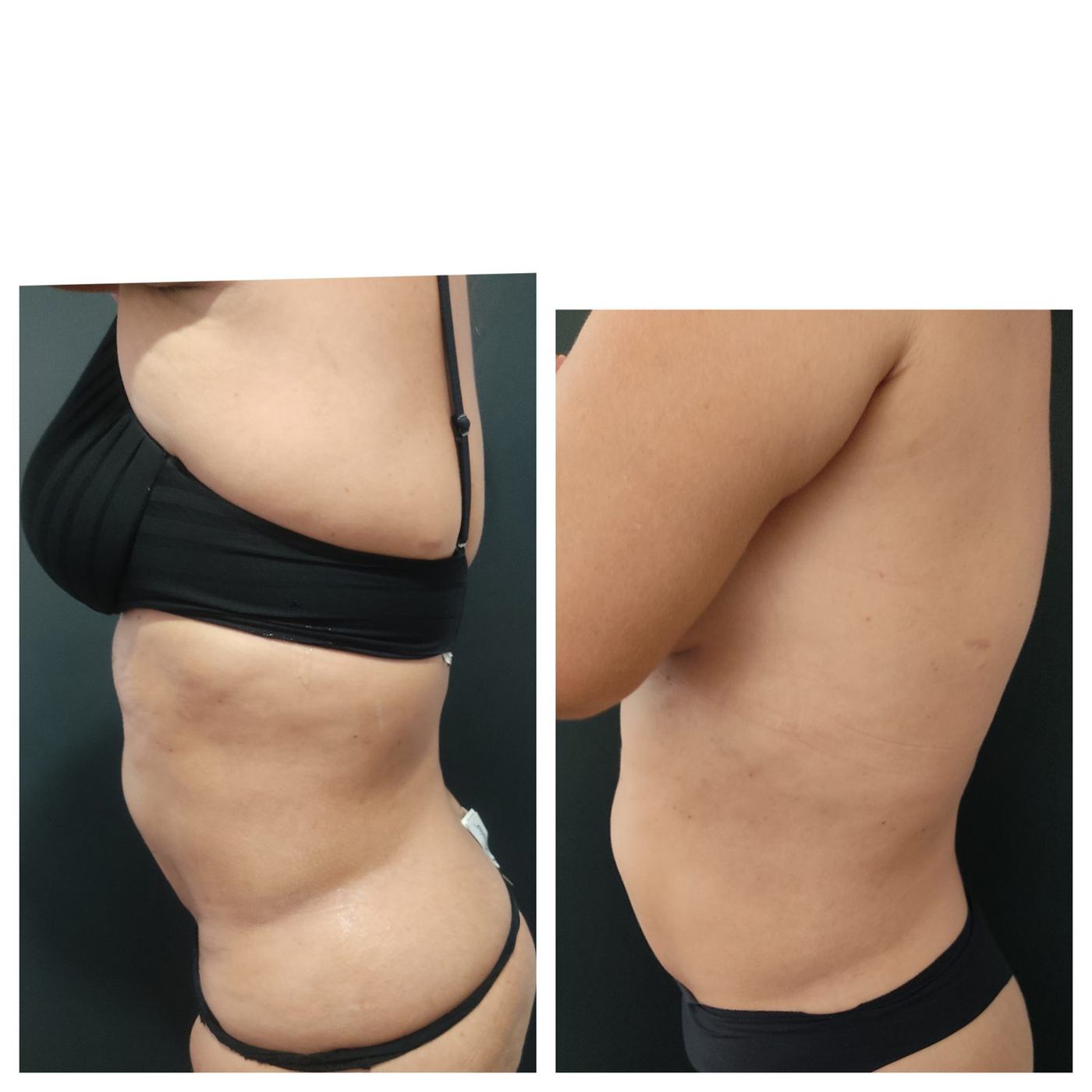 Lipoenzimas y fibrosis — fotografía clínica real