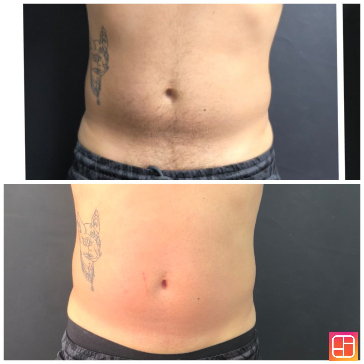 Lipoenzimas y fibrosis — fotografía clínica real