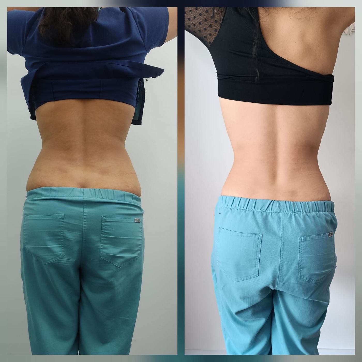 Lipoenzimas y fibrosis — fotografía clínica real