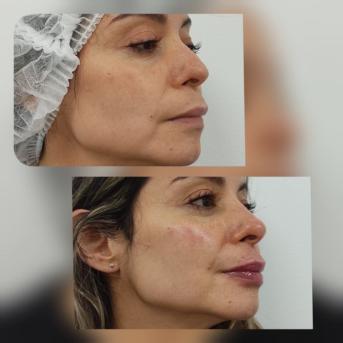 Armonización facial — general — fotografía clínica real