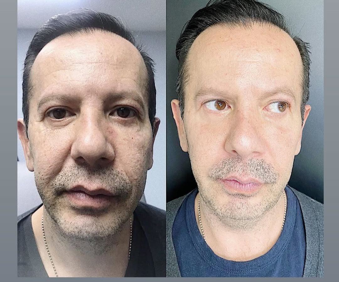 Armonización facial — general — fotografía clínica real