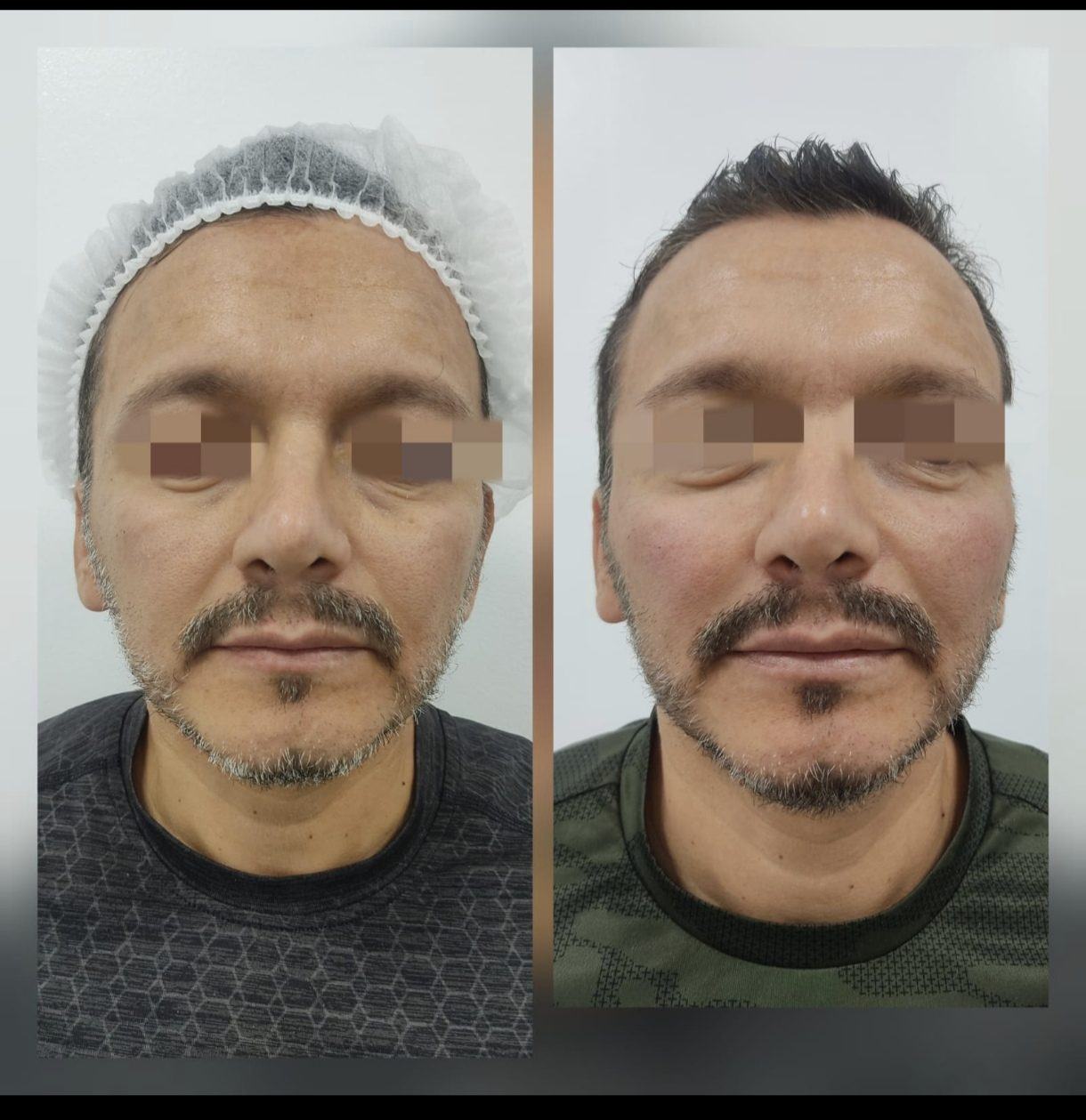 Armonización facial — general — fotografía clínica real