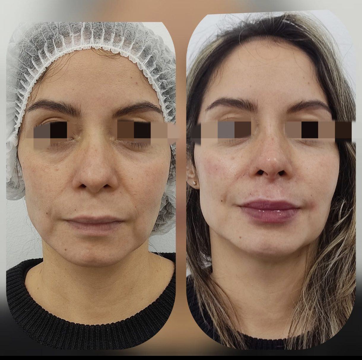 Armonización facial — general — fotografía clínica real