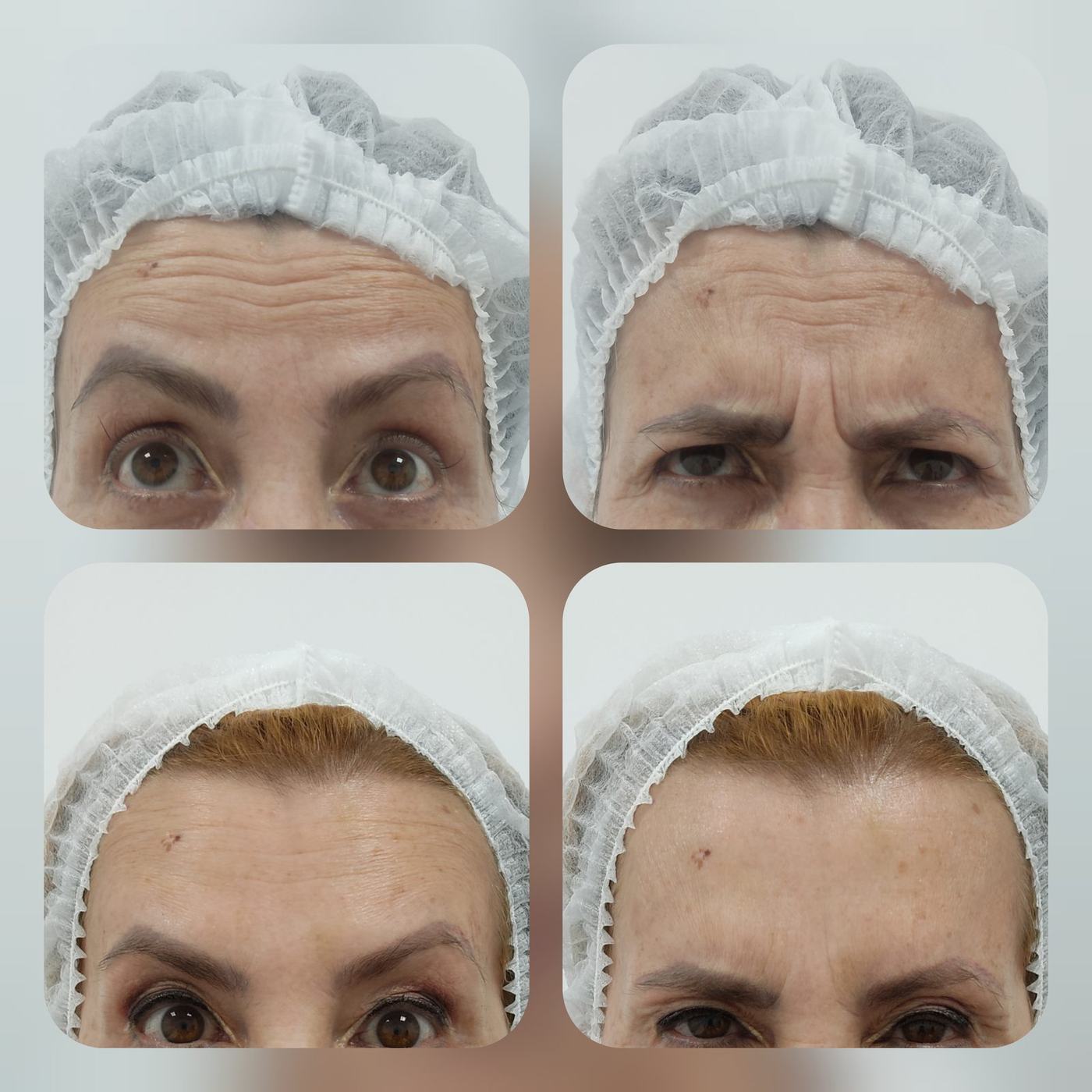 Resultados de Botox