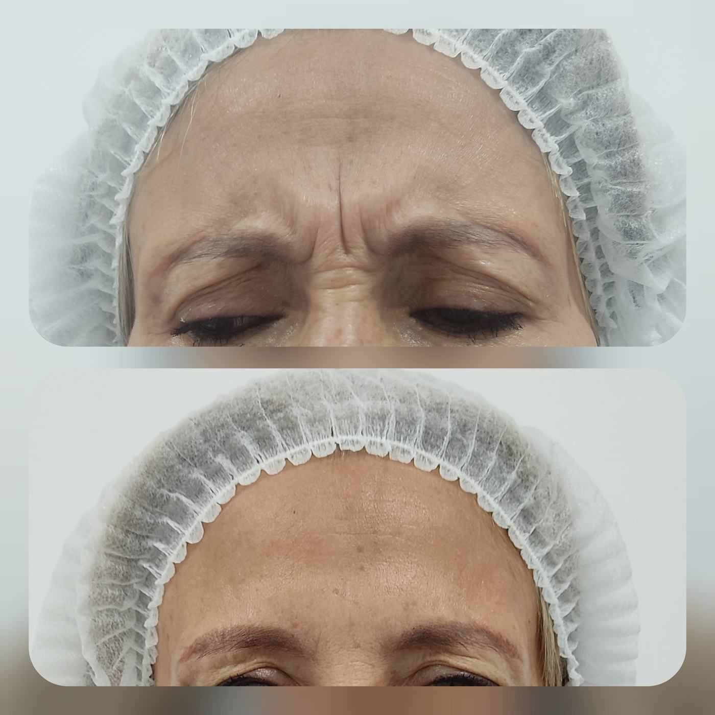 Botox — fotografía clínica real