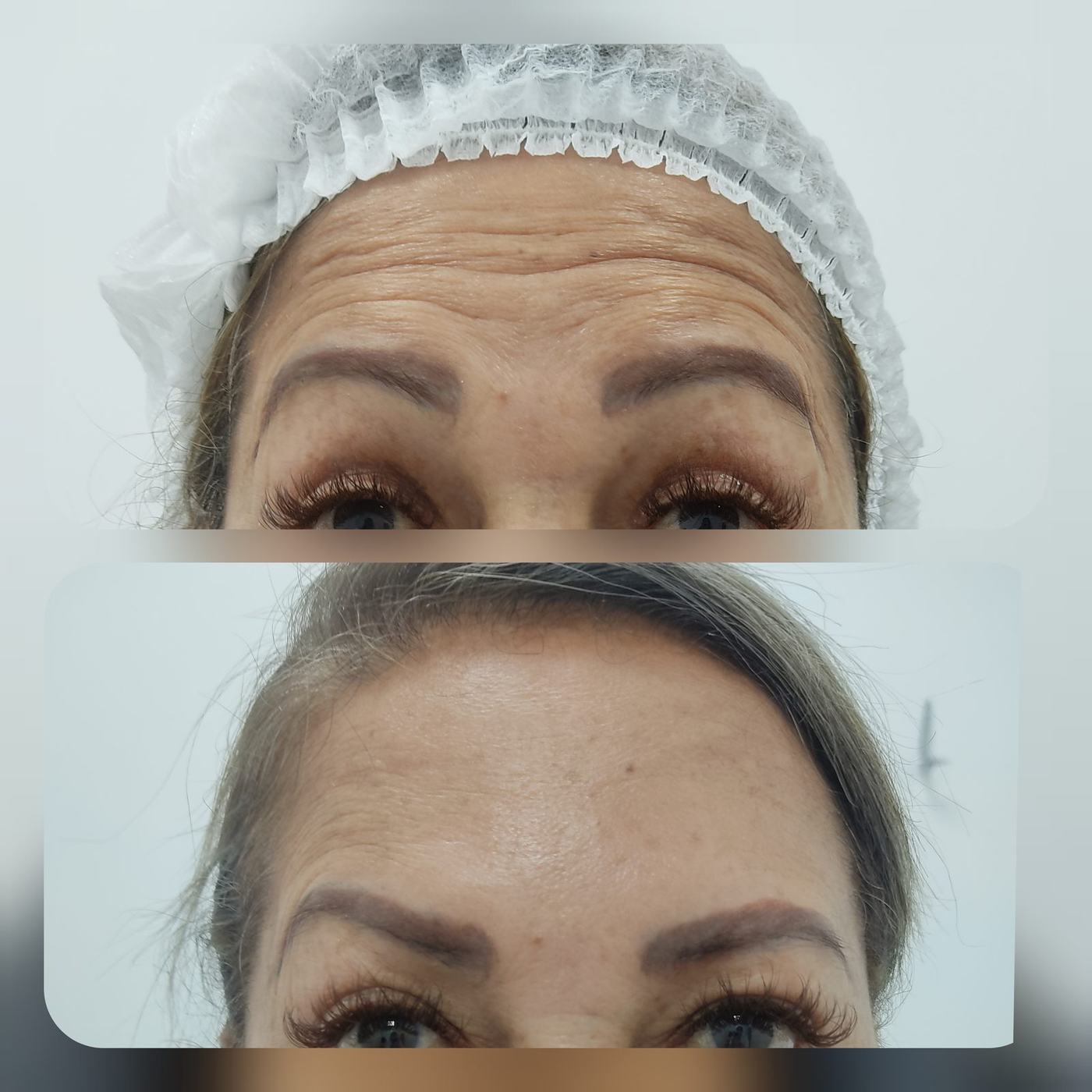 Botox — fotografía clínica real