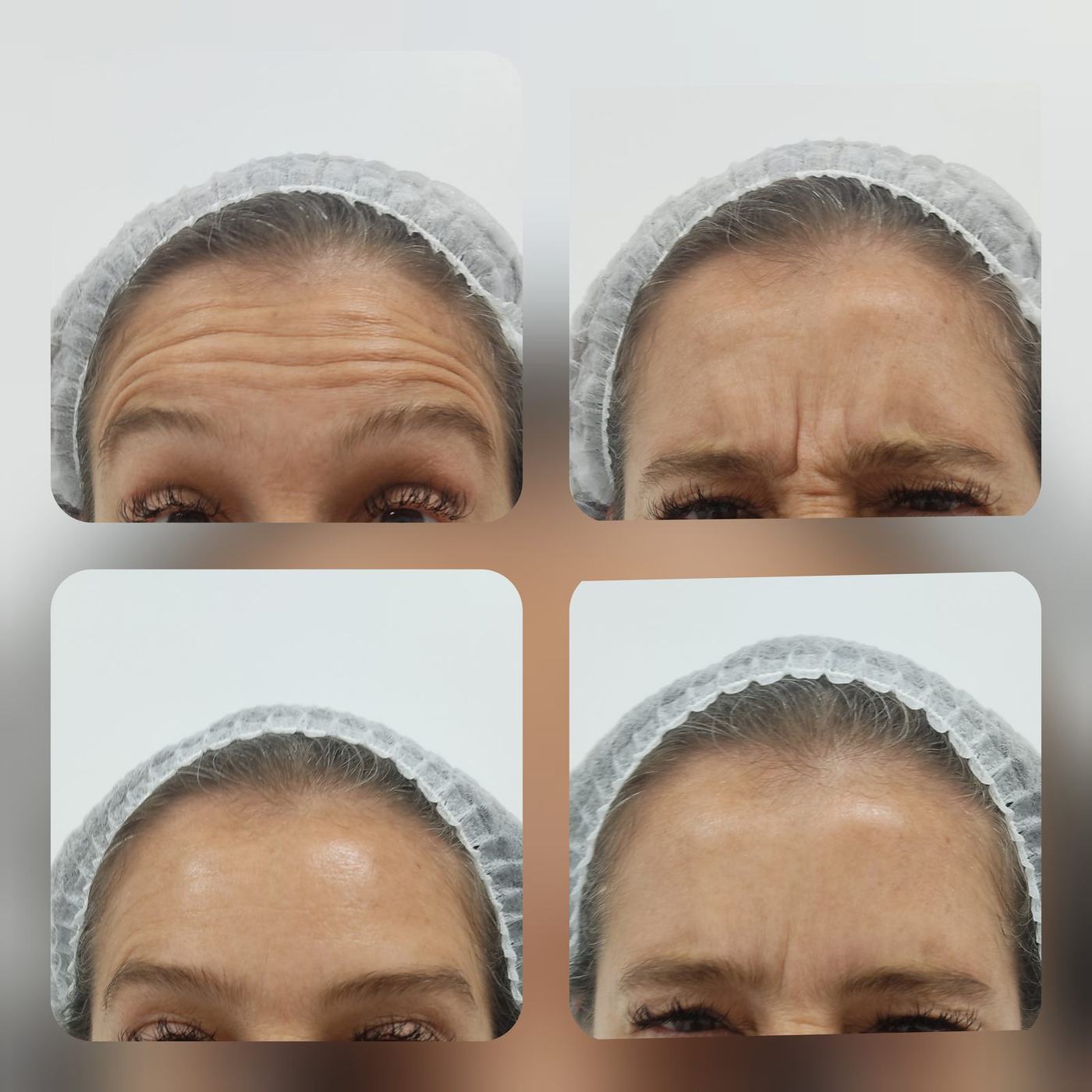 Botox — fotografía clínica real