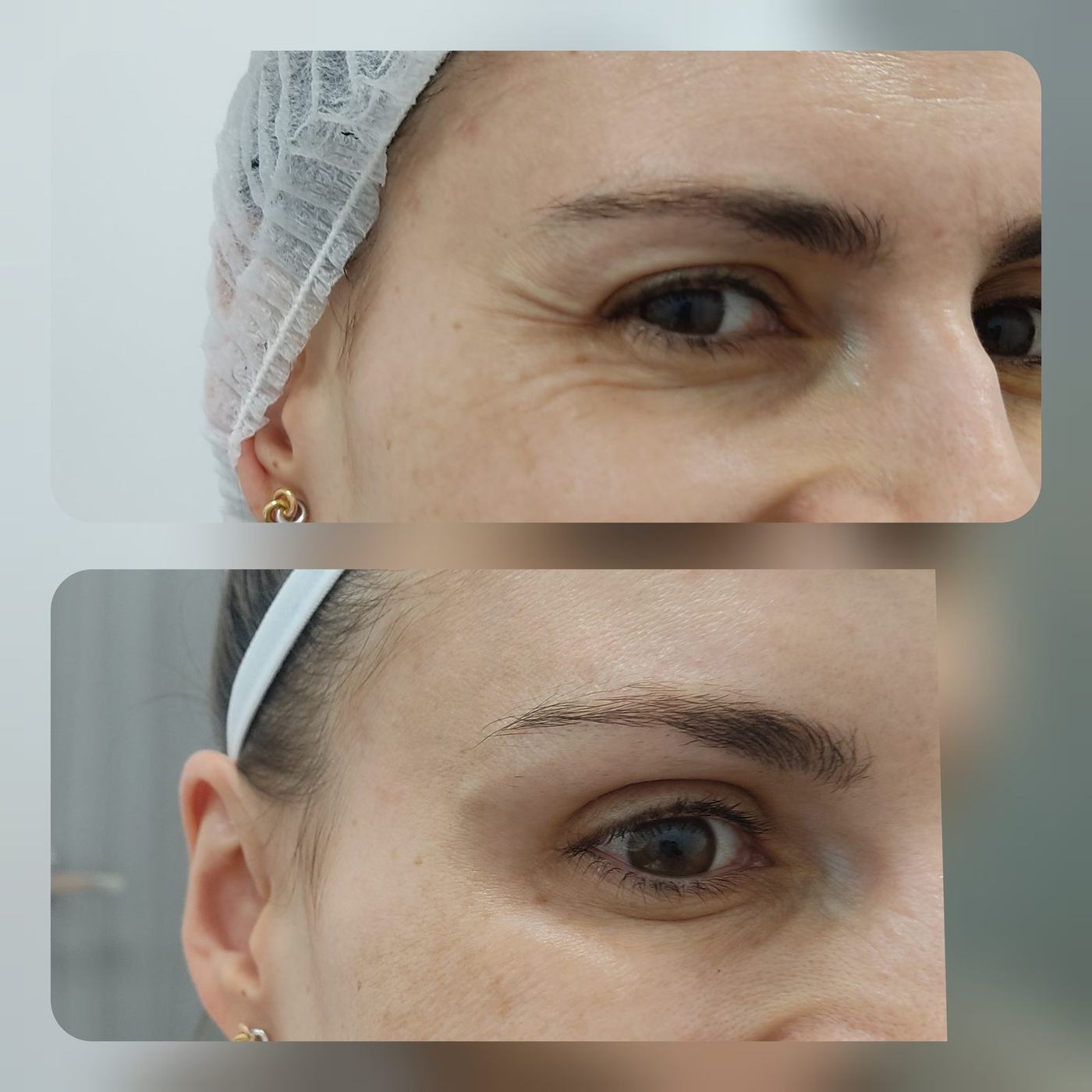 Botox — fotografía clínica real