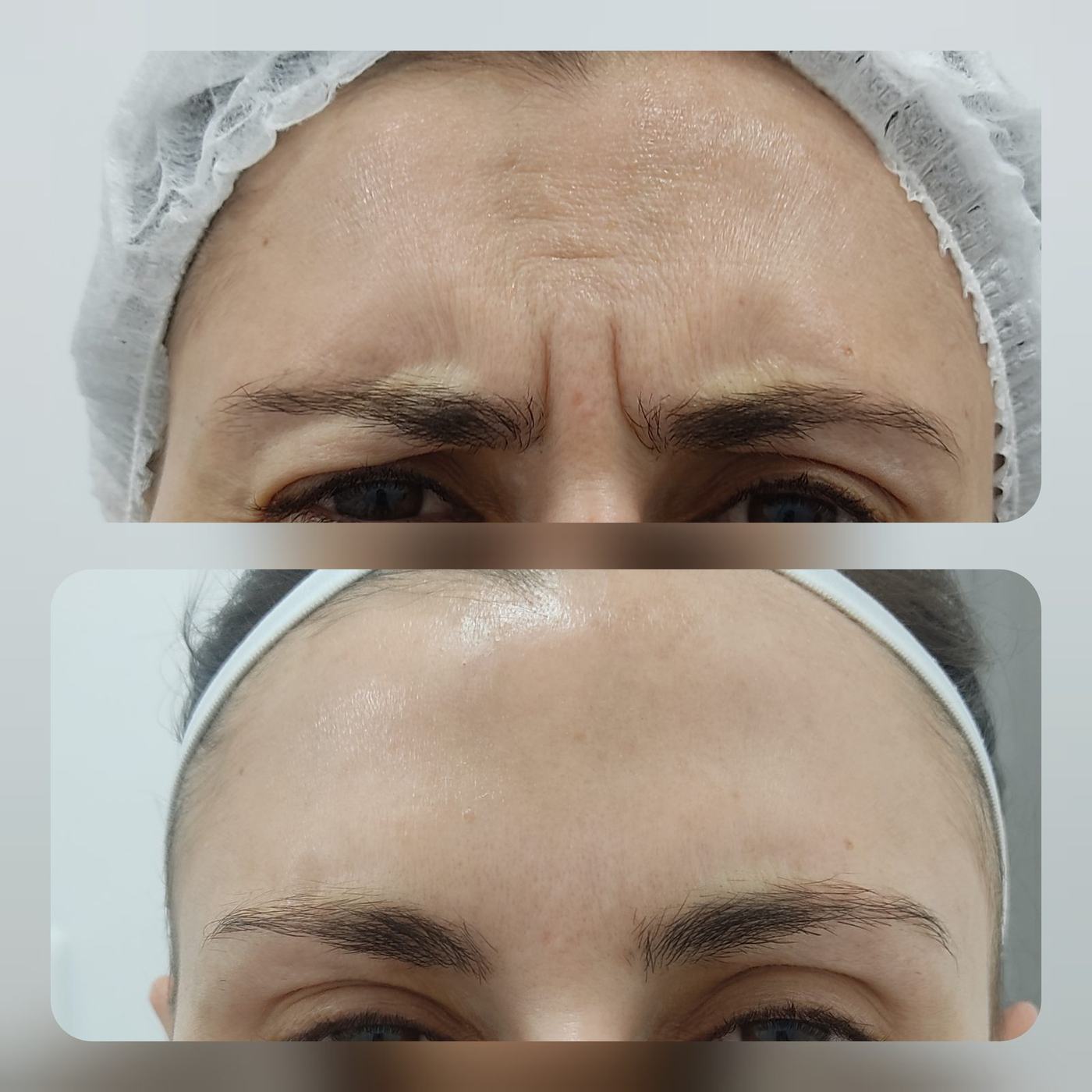 Botox — fotografía clínica real
