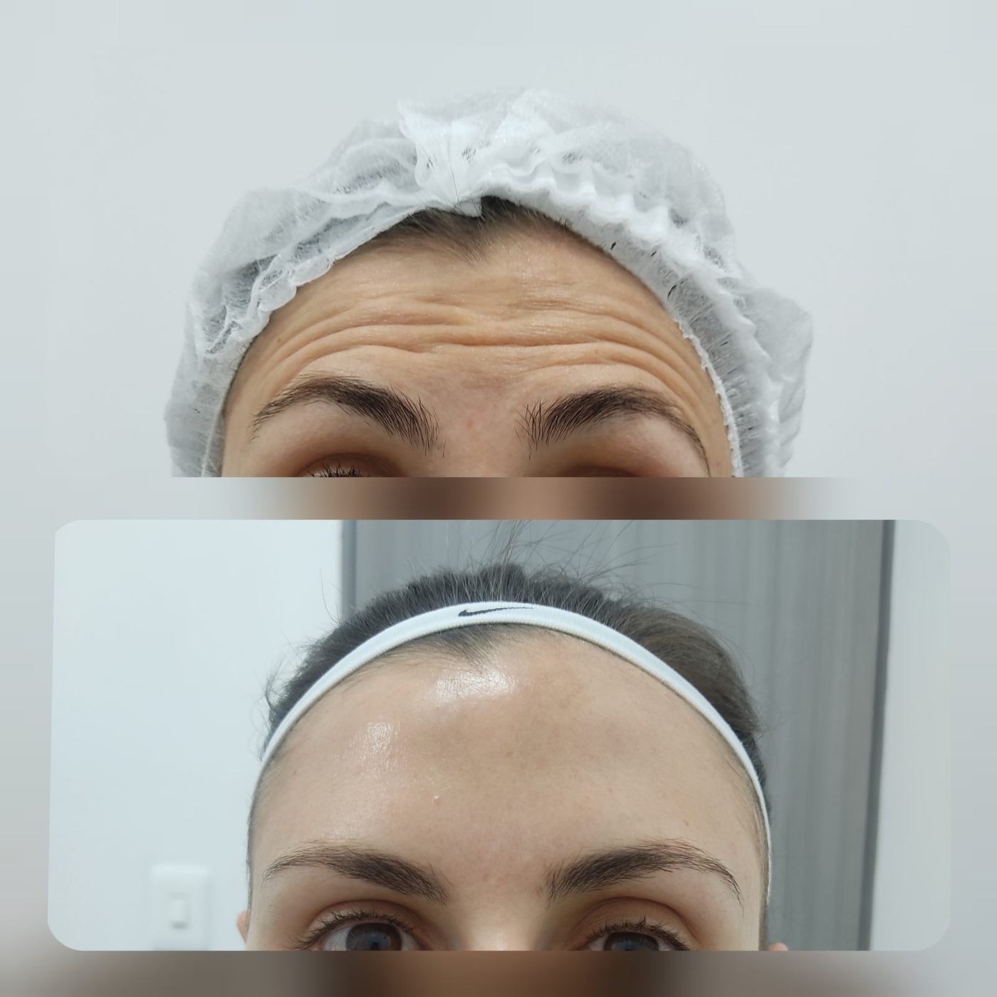 Botox — fotografía clínica real