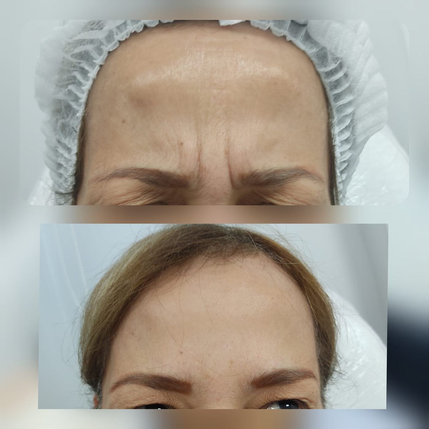 Botox — fotografía clínica real