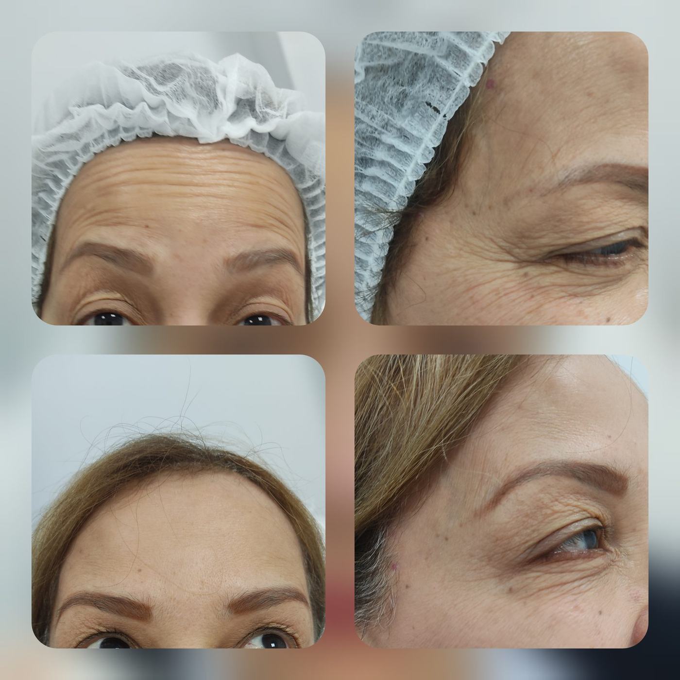 Botox — fotografía clínica real