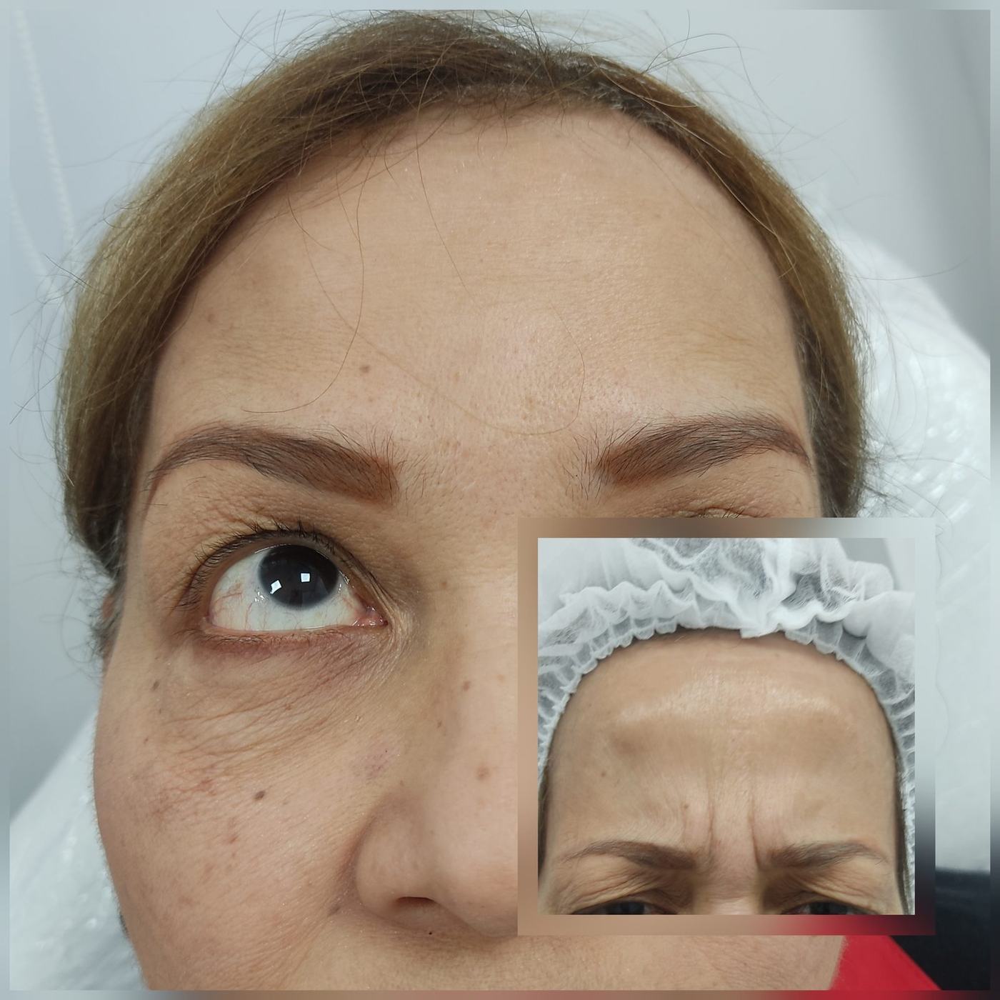 Botox — fotografía clínica real