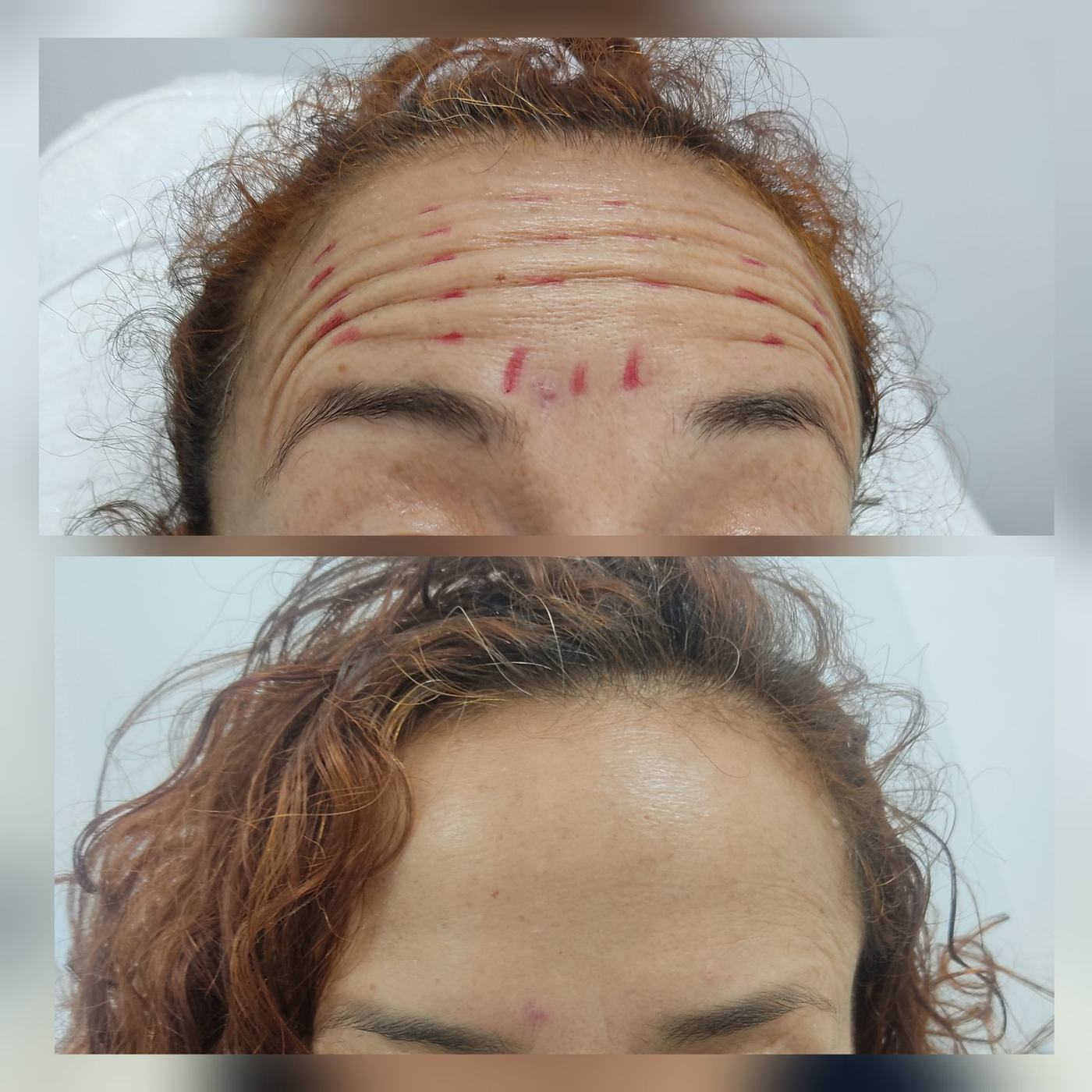 Botox — fotografía clínica real