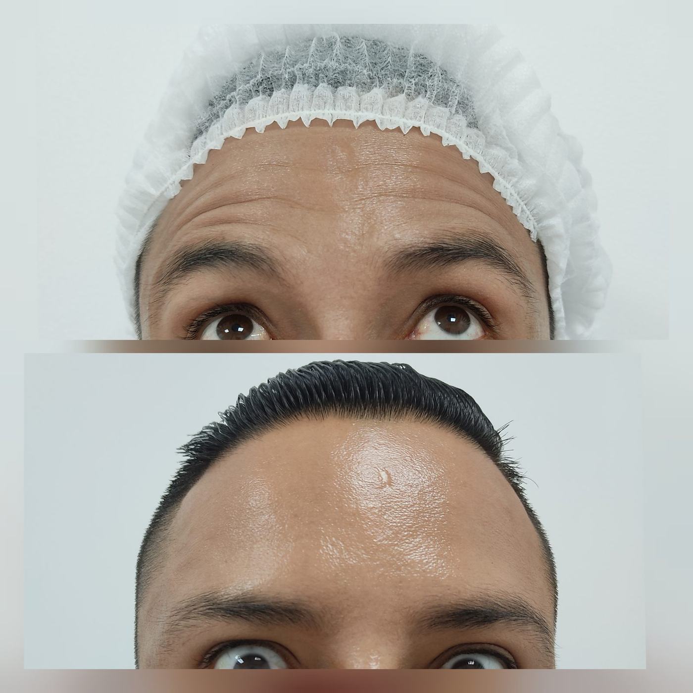 Botox — fotografía clínica real