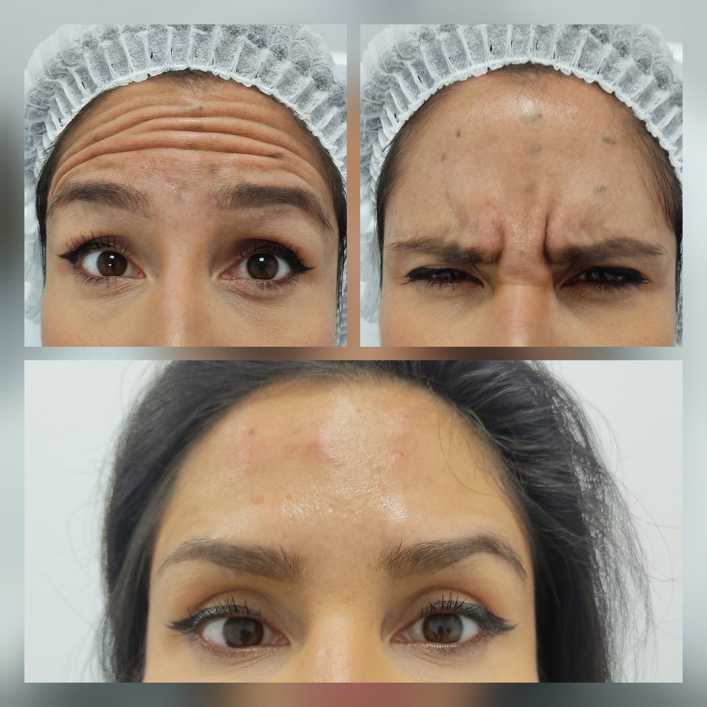 Botox — fotografía clínica real