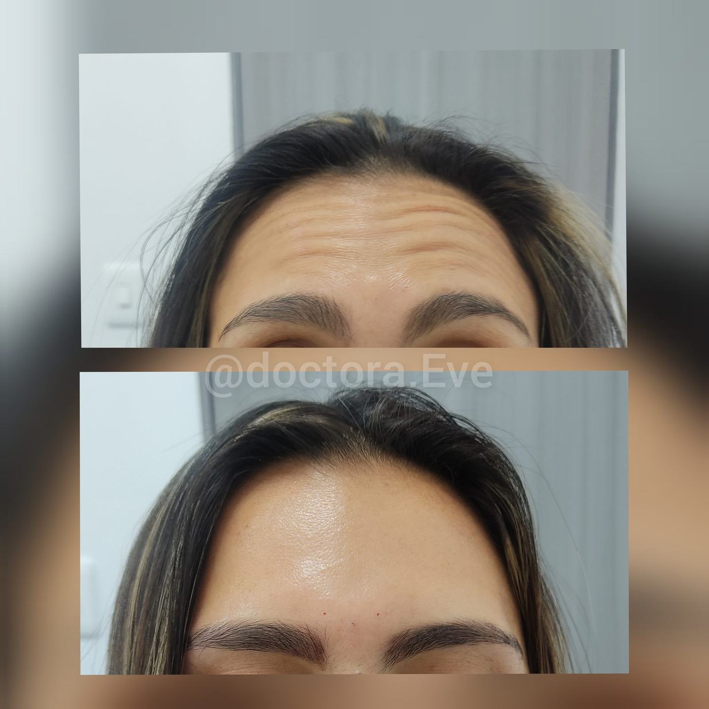 Botox — fotografía clínica real