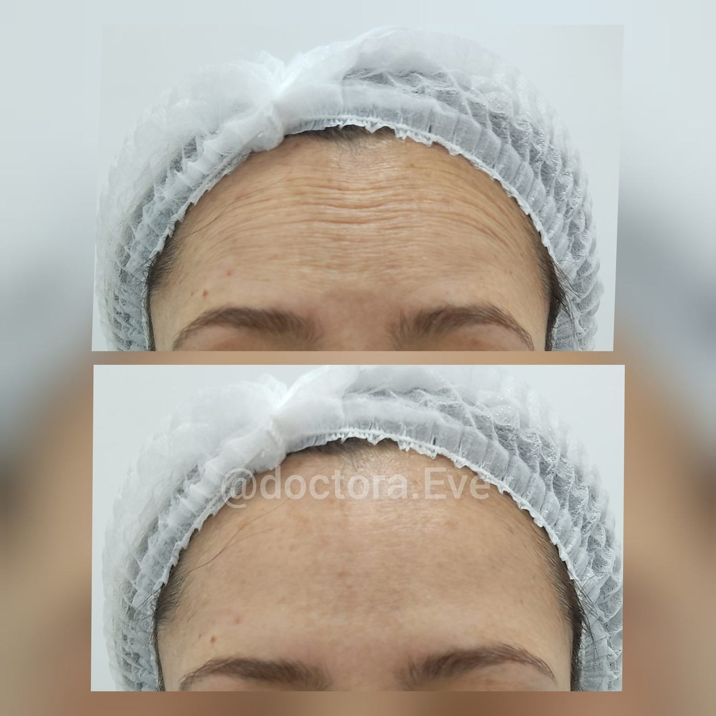 Botox — fotografía clínica real