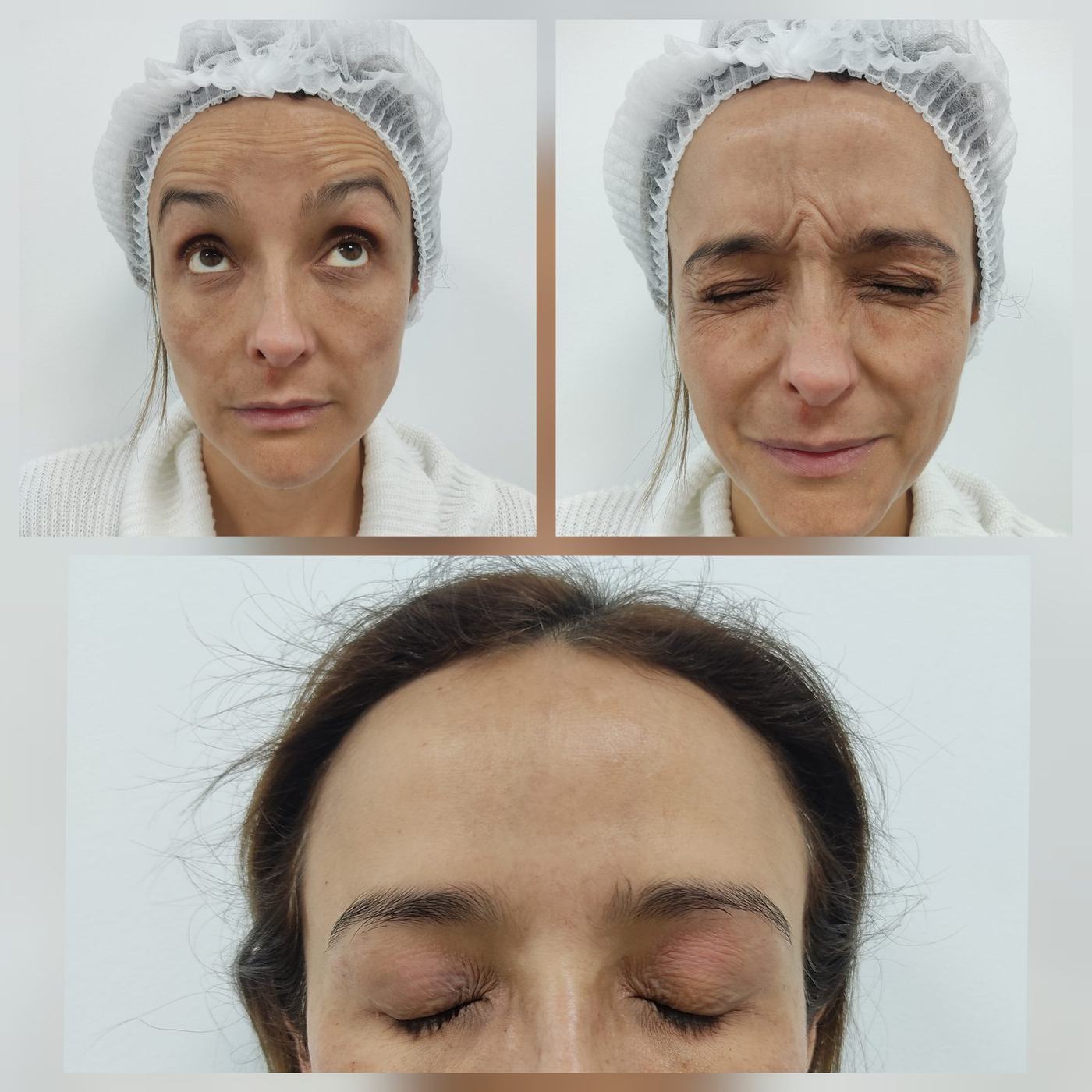 Botox — fotografía clínica real