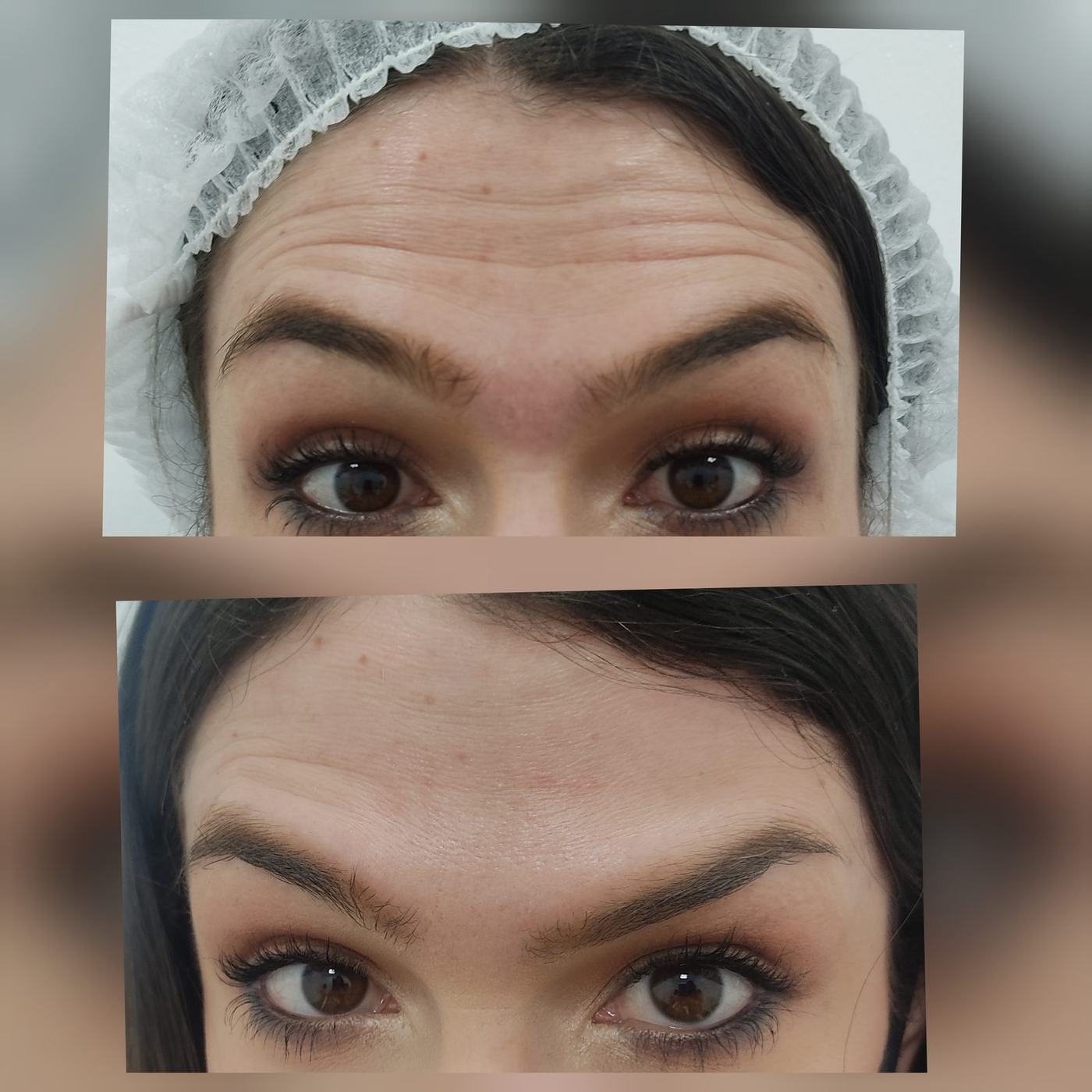Botox — fotografía clínica real