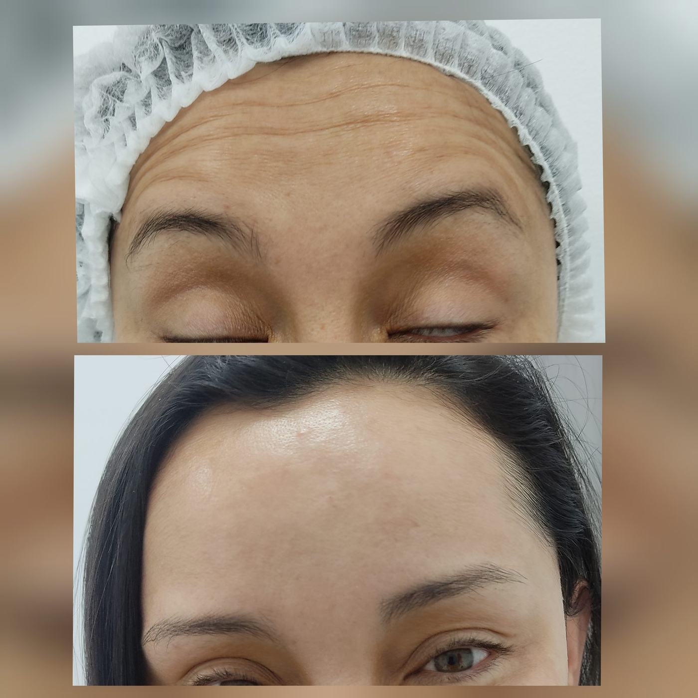 Botox — fotografía clínica real