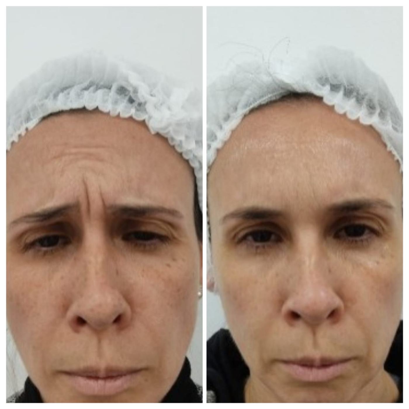 Botox — fotografía clínica real