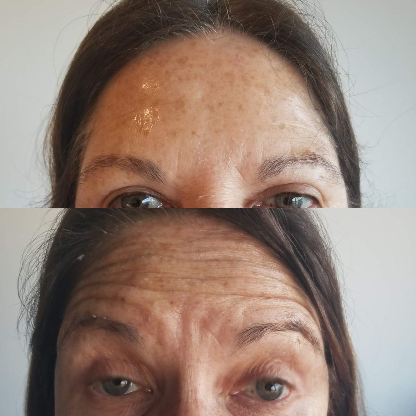 Botox — fotografía clínica real