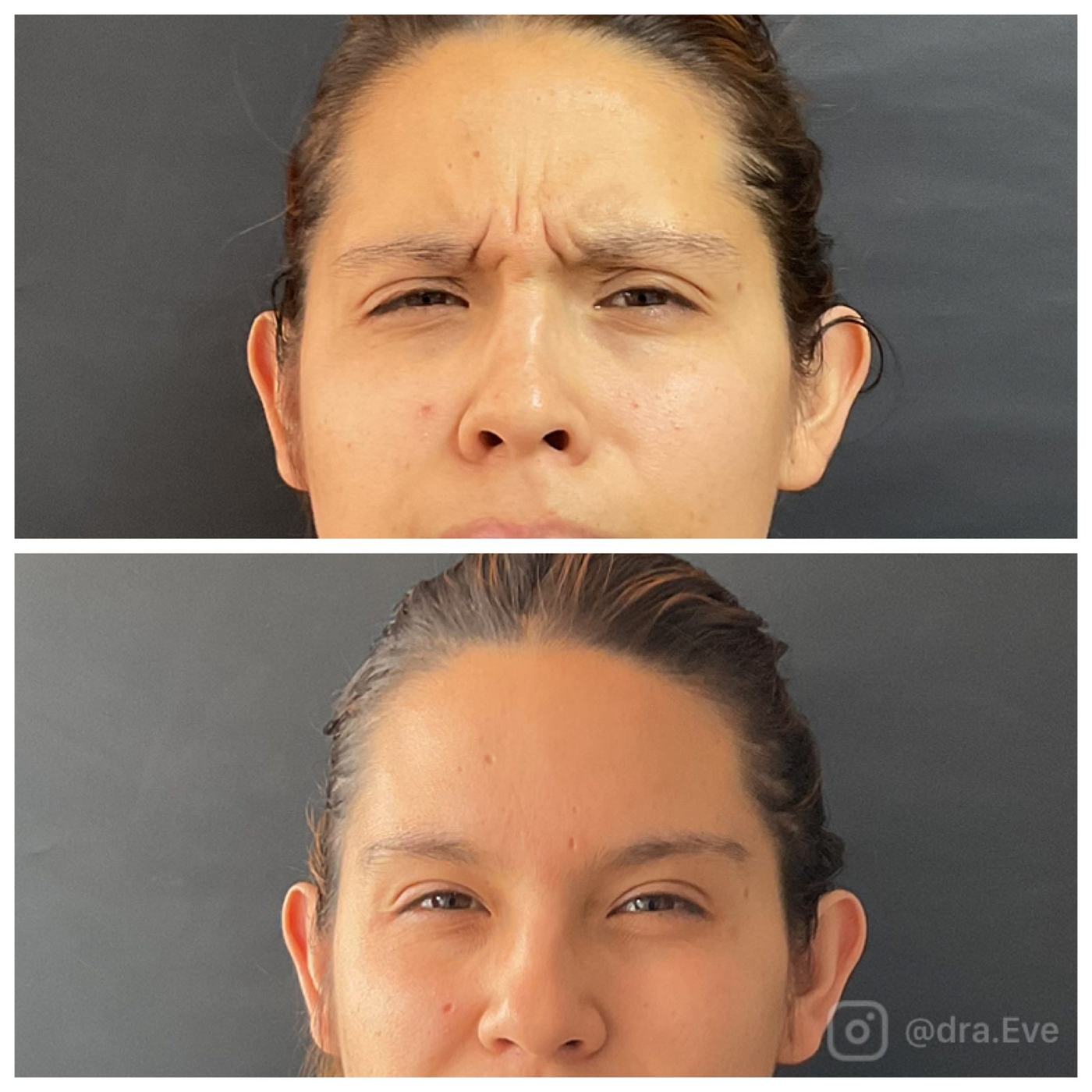 Botox — fotografía clínica real