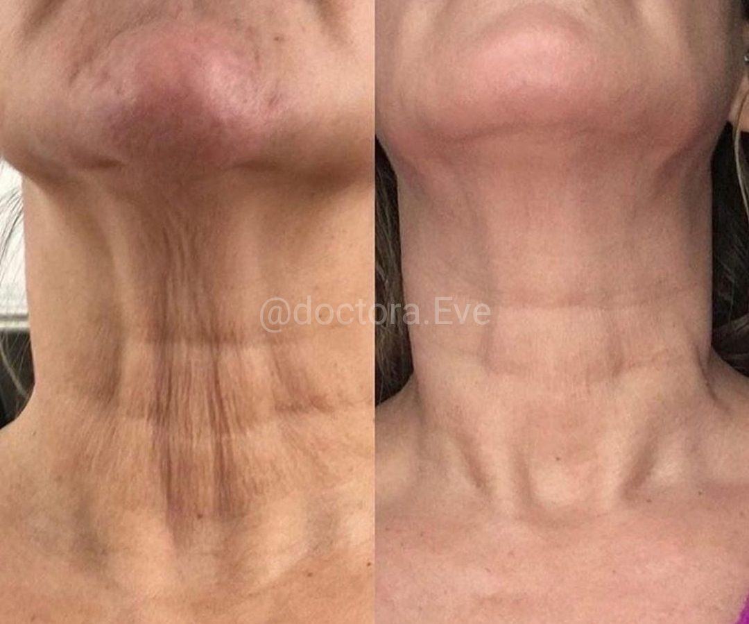 Cuello y escote — fotografía clínica real