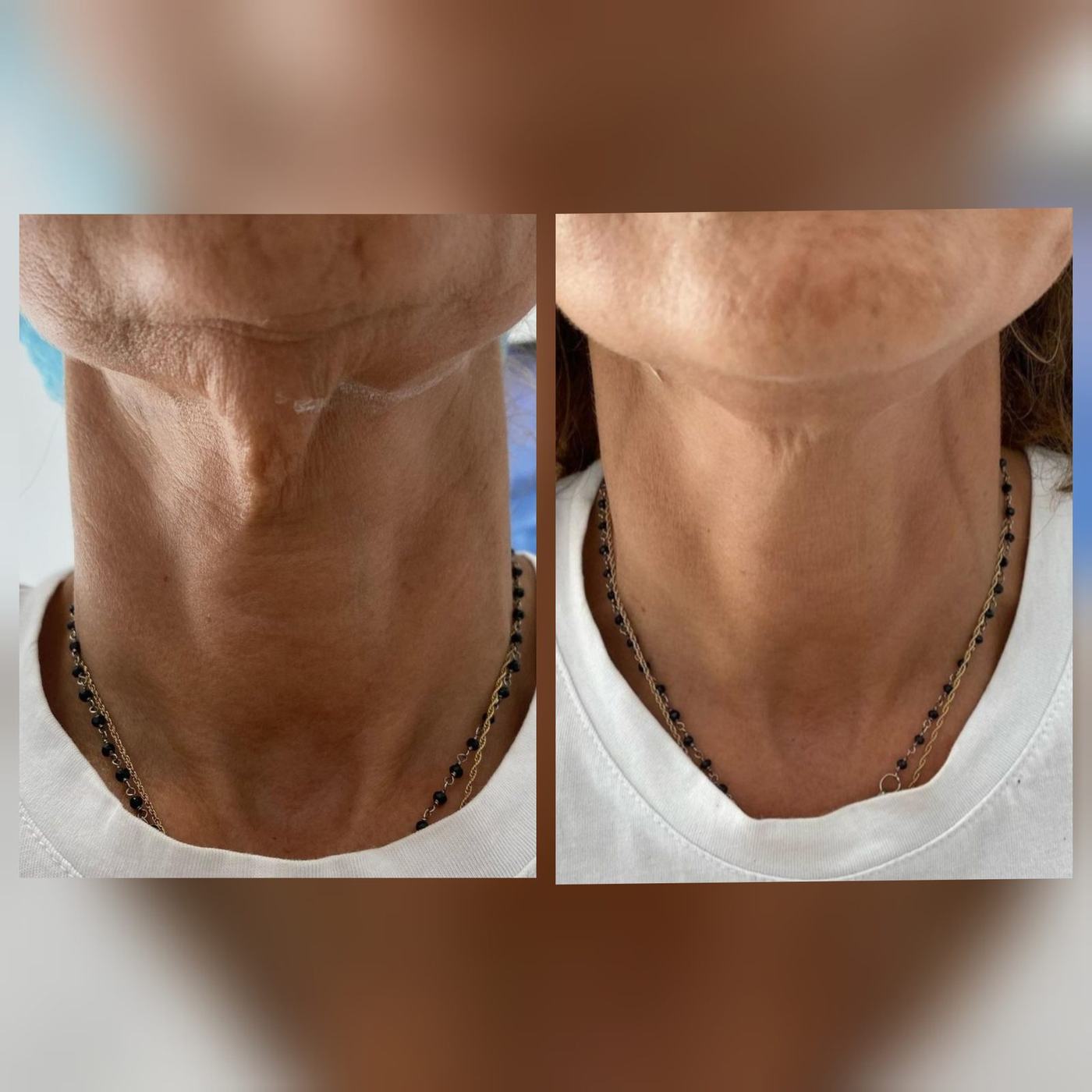 Cuello y escote — fotografía clínica real