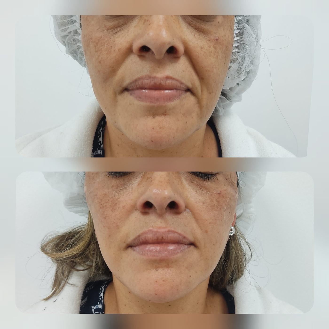 Hilos tensores (rostro) — fotografía clínica real