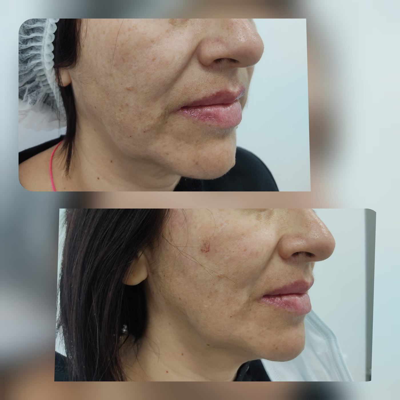 Hilos tensores (rostro) — fotografía clínica real