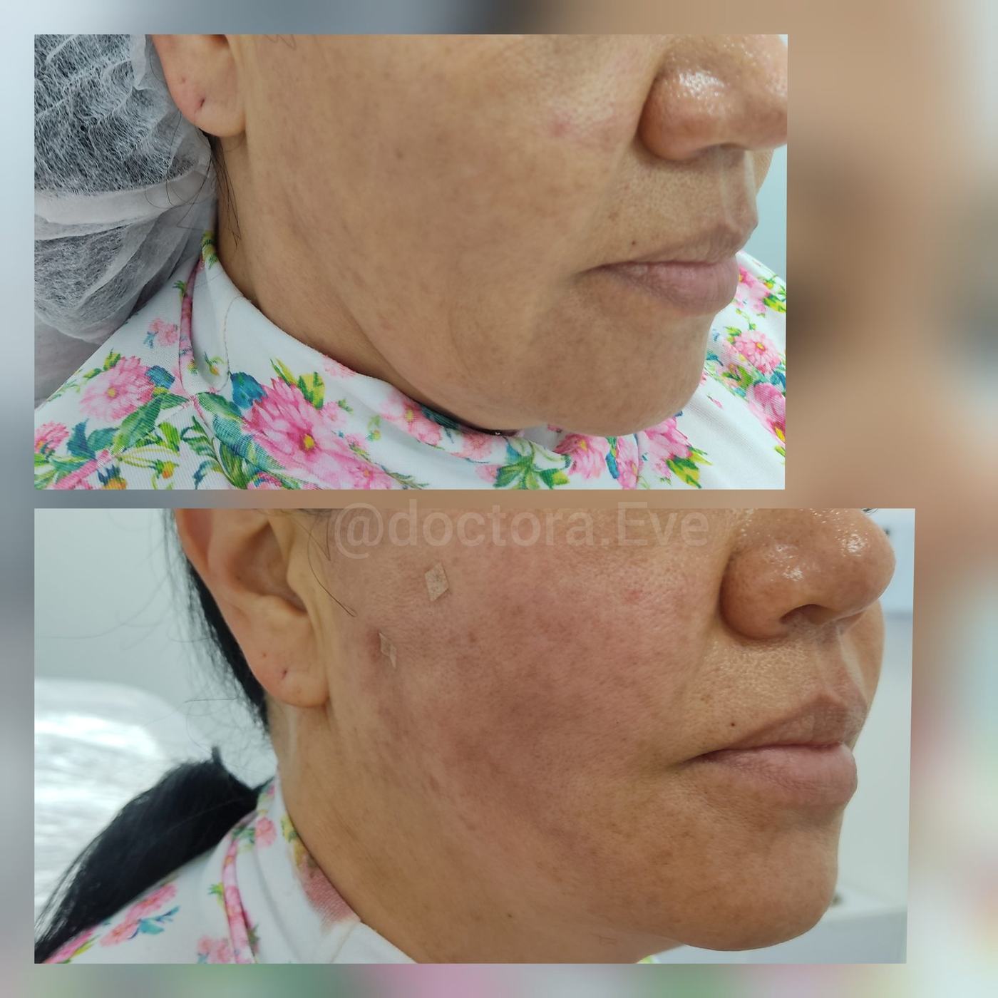 Hilos tensores (rostro) — fotografía clínica real