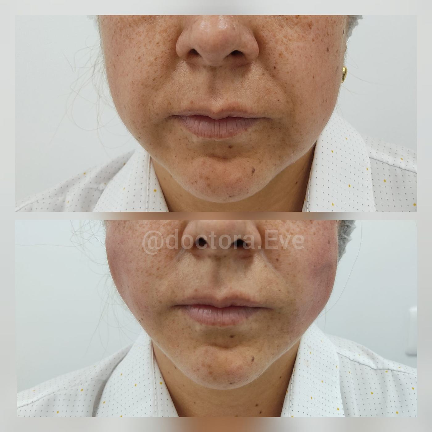Hilos tensores (rostro) — fotografía clínica real