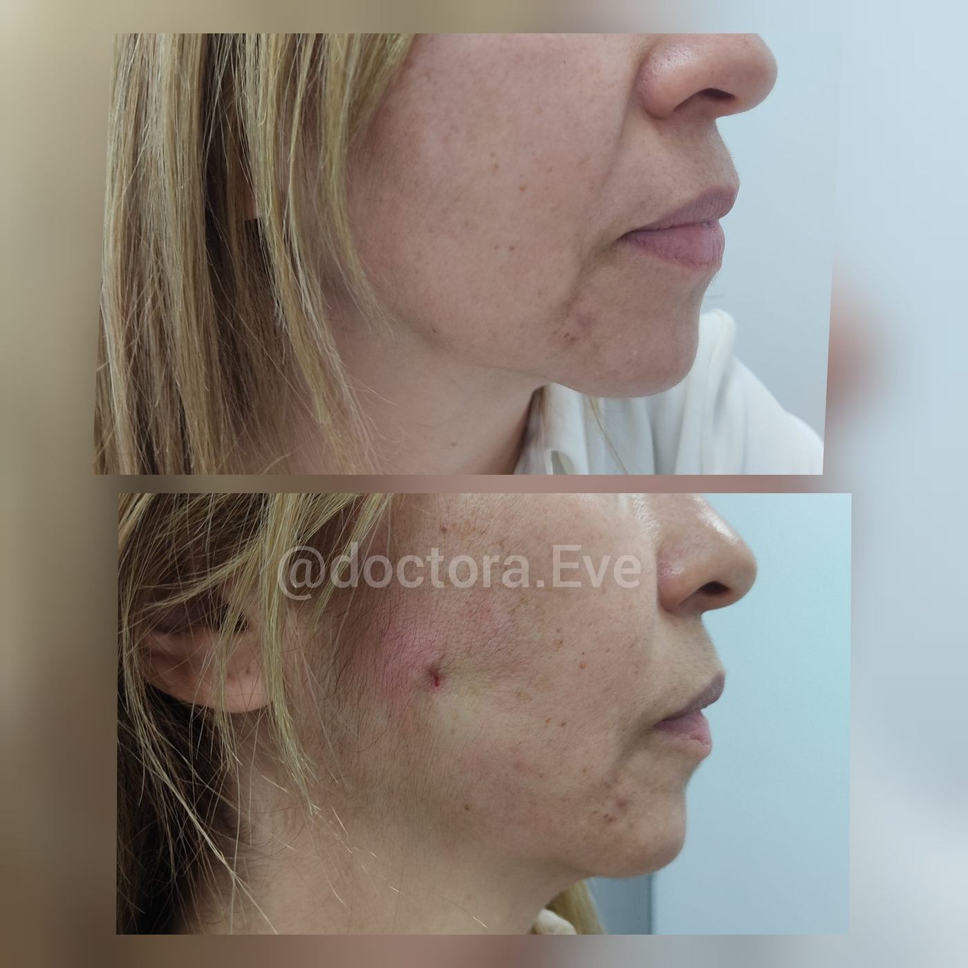 Hilos tensores (rostro) — fotografía clínica real