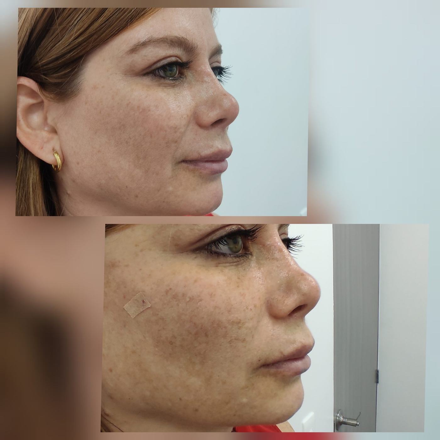 Hilos tensores (rostro) — fotografía clínica real