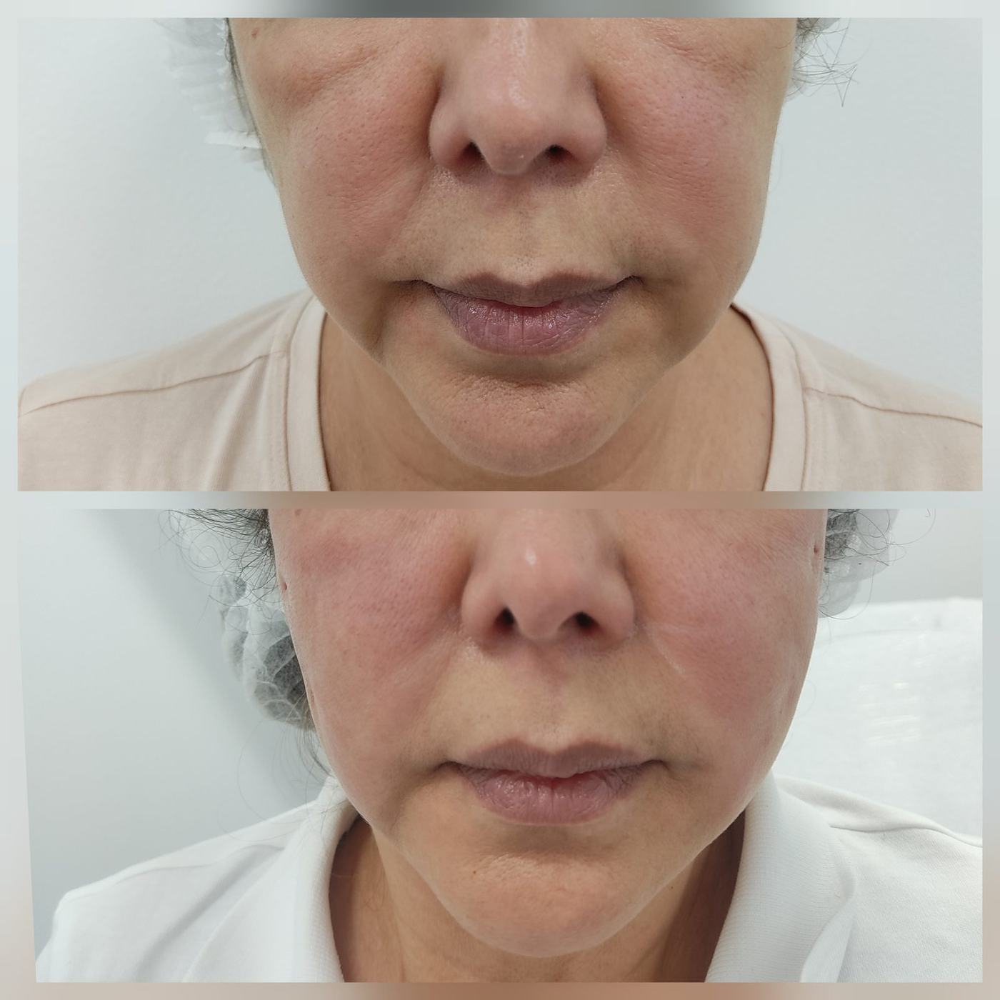 Hilos tensores (rostro) — fotografía clínica real