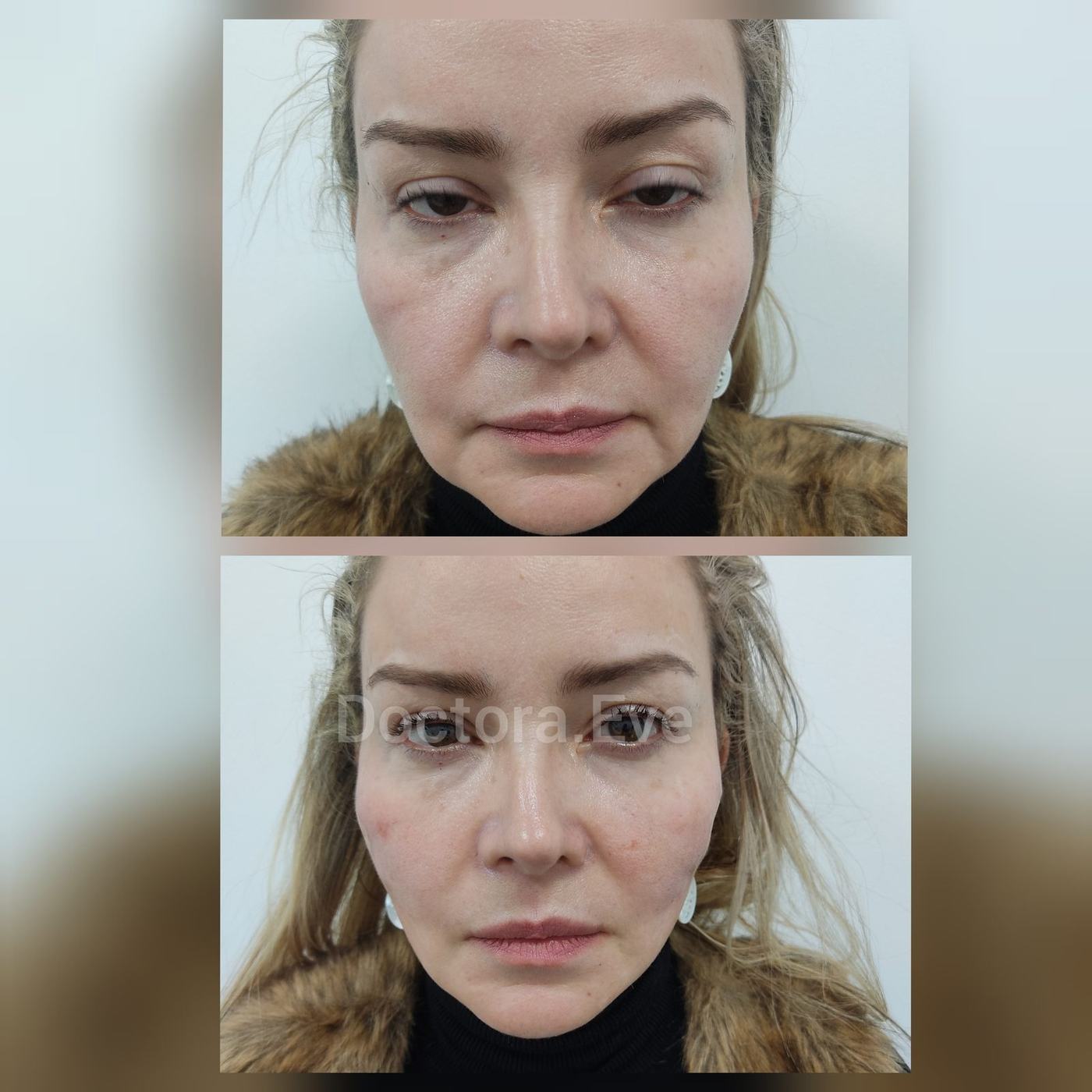 Hilos tensores (rostro) — fotografía clínica real