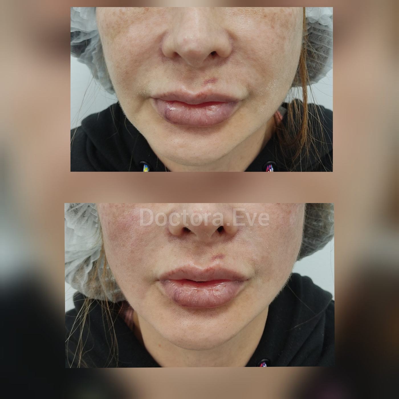 Hilos tensores (rostro) — fotografía clínica real