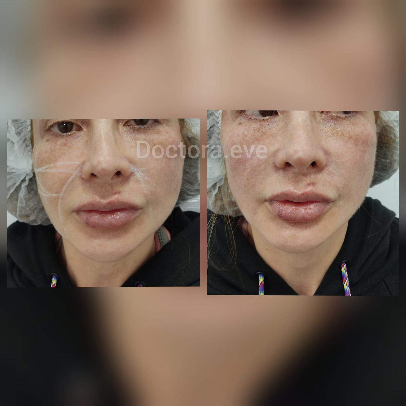 Hilos tensores (rostro) — fotografía clínica real